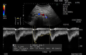 Abdomen Arterial Renal