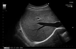 Abdomen Modo B Hígado Arietta 50
