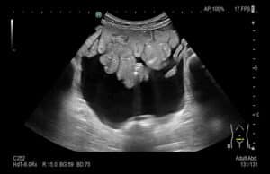 Abdomen Modo B Vejiga Arietta 750
