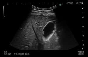Abdomen Modo B Vesícula Biliar Arietta 750