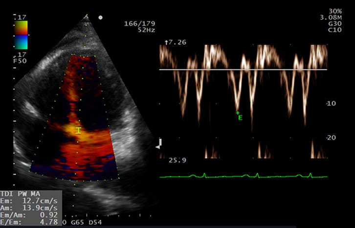 Cardiaco Doppler de tejidos (TDI) Corazon