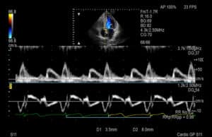 Cardiología Doppler Doble Puerta Corazon Arietta 750