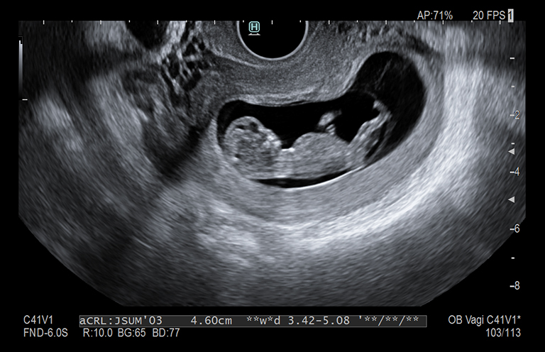 Obstetricia Feto 11 semanas Arietta