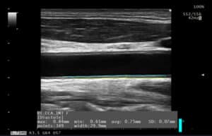 Vascular Auto IMT de modo B Arteria Carotida