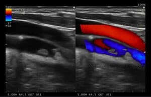 Vascular CF Dual Arteria Carotida