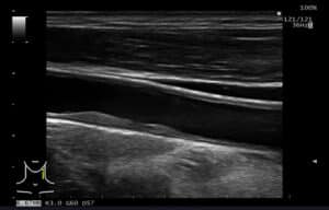Vascular Modo M Arteria Carotida