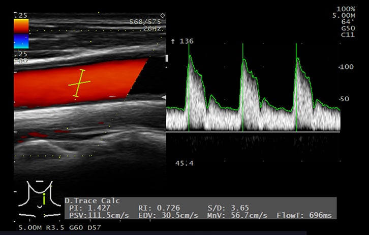 Vascular PW (Trazado automático Doppler) Carotida