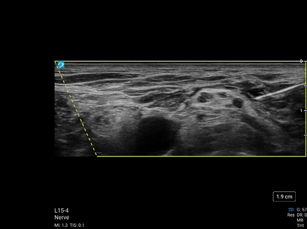 Bloqueo-Plexo-Supraclavicular-Sonosite