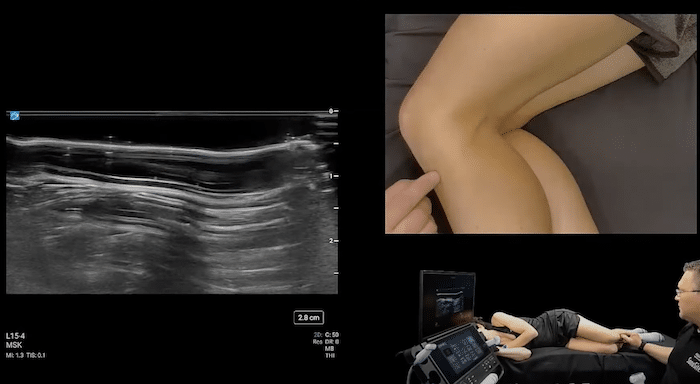 Evaluación Rodilla Ultrasonido