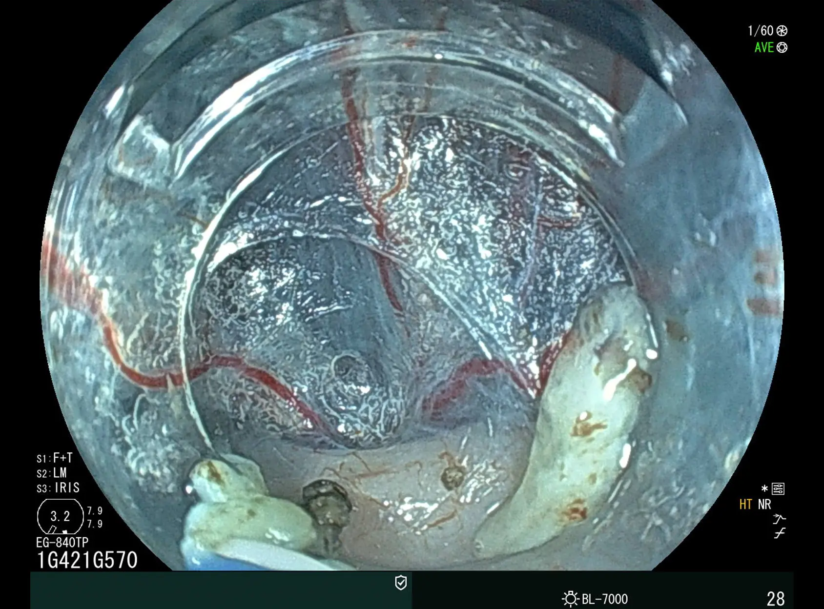 Endoscopia Eluxeo 8000 - Imagen 4