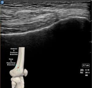 Crioanalgesia guiada por ecografía rodilla