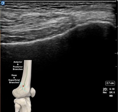 Crioanalgesia guiada por ecografía rodilla